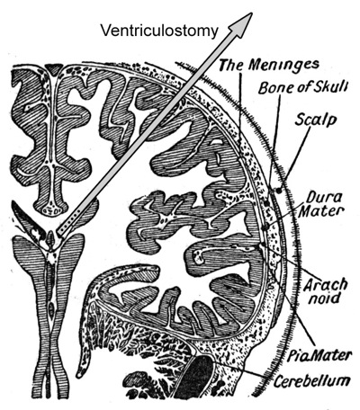 External Ventricular Device