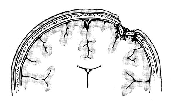 brain injury