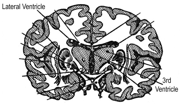 hydrocephalus